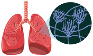 Tuberculosis tests