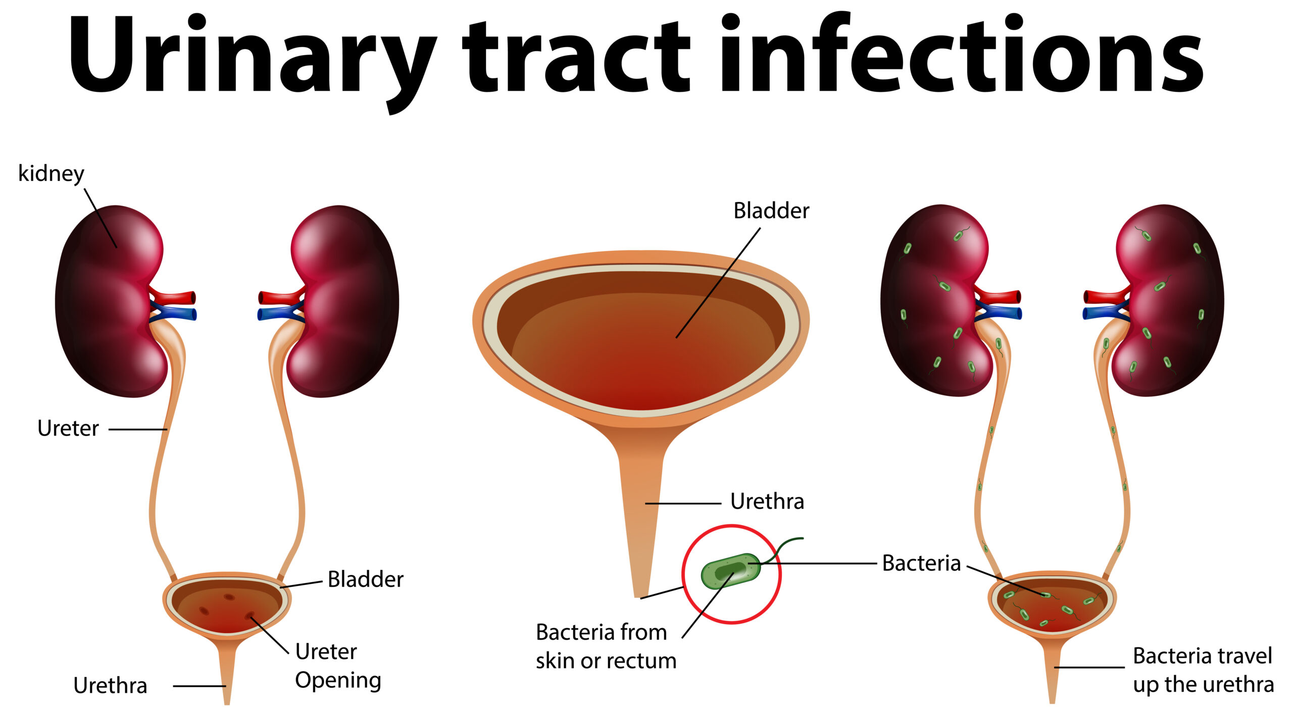 Urinary tract infection symptoms